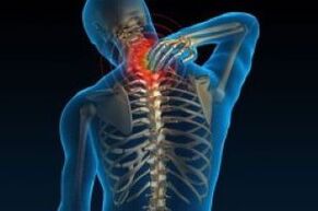 Osteochondroza cervicală duce la dureri la nivelul gâtului