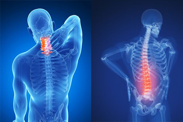 Osteocondroza coloanei cervicale și lombare