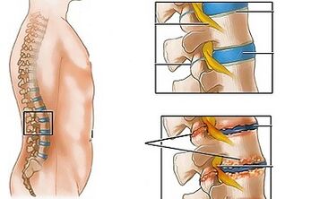 Cauzele osteochondrozei lombare