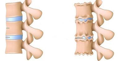 Cum să recunoaștem prezența osteochondrozei lombare